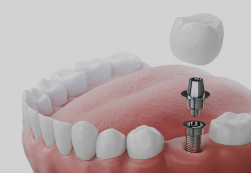 임플란트 가격 확인 최저가 확인 시술기간 (최신)