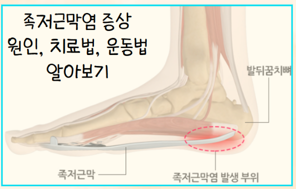 족저 근막염 증상