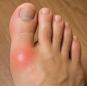 통풍에 좋은 음식