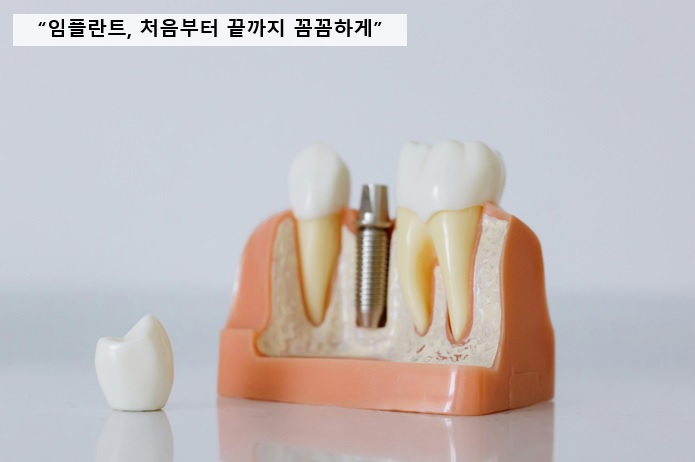 임플란트, 처음부터 끝까지 꼼꼼하게