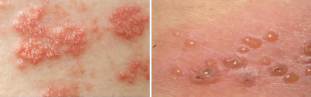 피부에-대상포진이-생겼을때-수포-올라온-사진