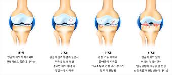 2025년 최신 무릎 연골 주사 종류 비교