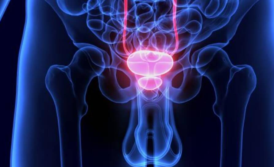 전립선비대증시술