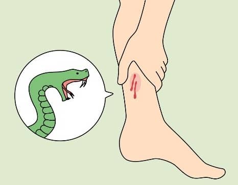 뱀 물렸을떄 이미지