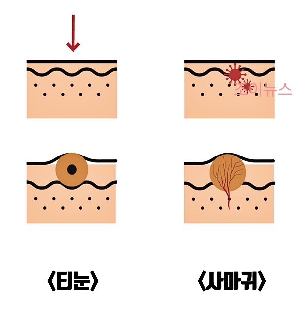 사마귀와 티눈의 원인적 차이점