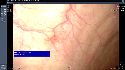 방광 내시경 사진