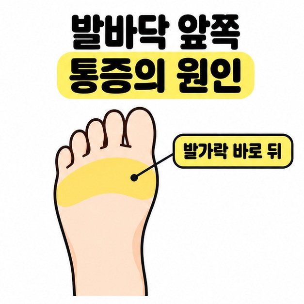 발바닥 앞쪽 통증의 원인 제목 아래 발가락 바로 뒤의 넓은 영역을 노란색으로 표시한 발바닥 그림