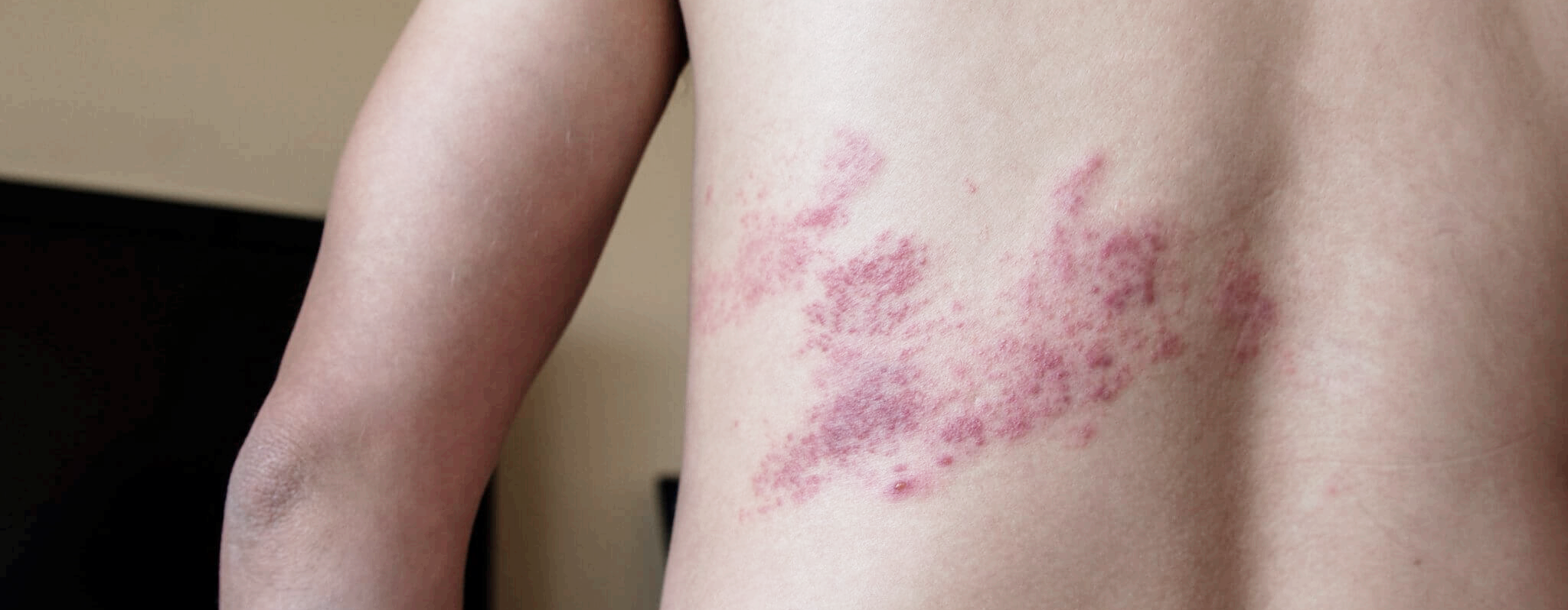 대상포진 초기증상