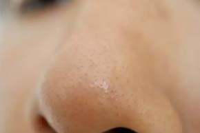 올바른 코 피지 제거법&amp;#44; 피지 원인&amp;#44; 모공 관리 총 정리 (2025 ver.)