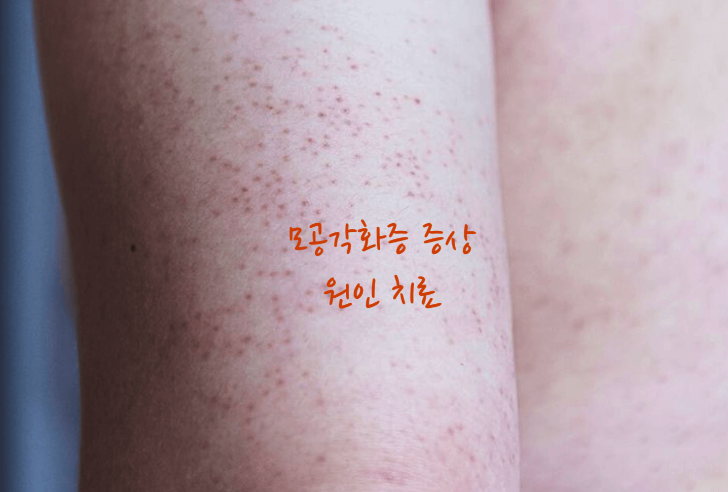 모공각화증 원인