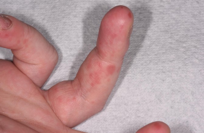 수족구병, 아이 건강을 지키는 필수 정보와 예방법