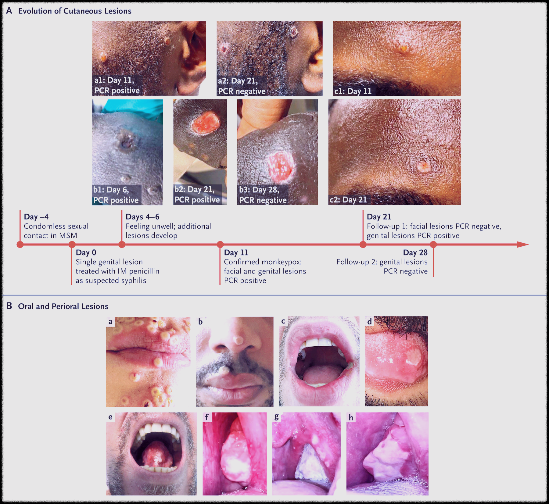 엠폭스 병변 사진