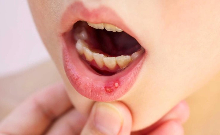 구내염 빨리 낫는 치료법