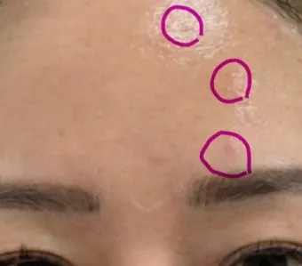 비립종 생기는 이유 비립종 없애는 방법 피부 관리법_22