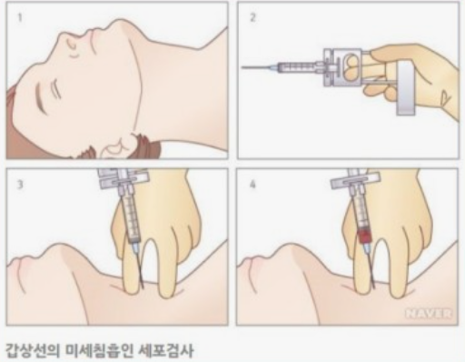 갑상선의 미세침흡인 세포검사 이미지