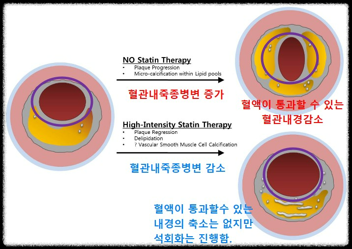 혈관 석회화 