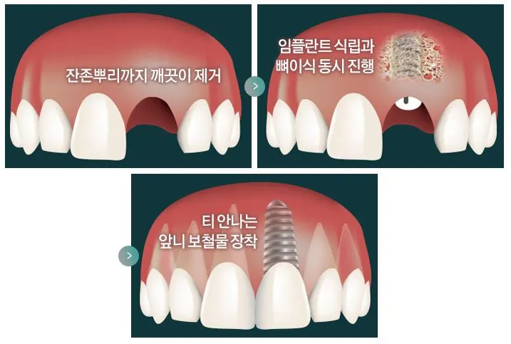 앞니 임플란트 수술 과정을 보여주는 사진이다.