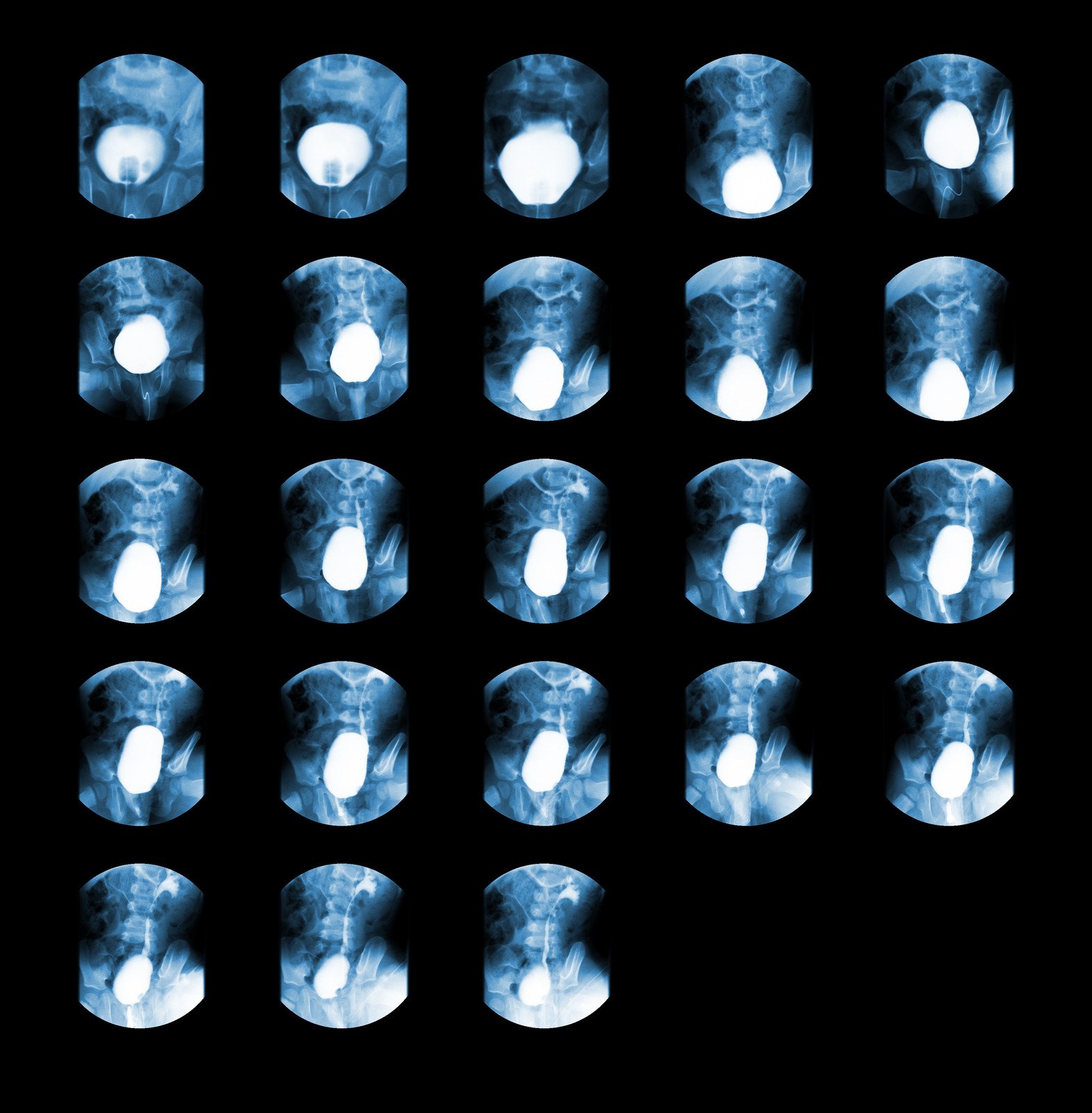 방광요도조영술