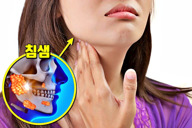 치통 심할때,갑자기 이가 아파요,침샘 결석 타석증