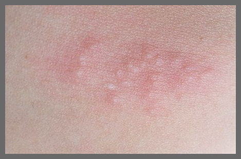 권연벌레 물린자국 퇴치법