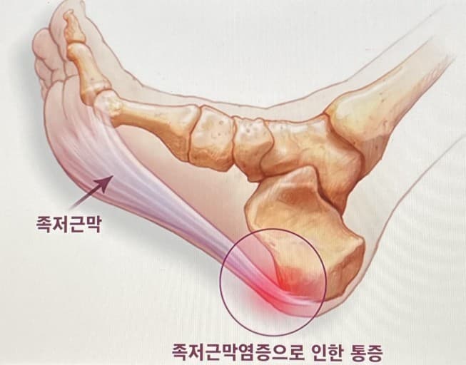 족저근막염과 족근관중후군