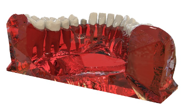 임플란트 식립 수술