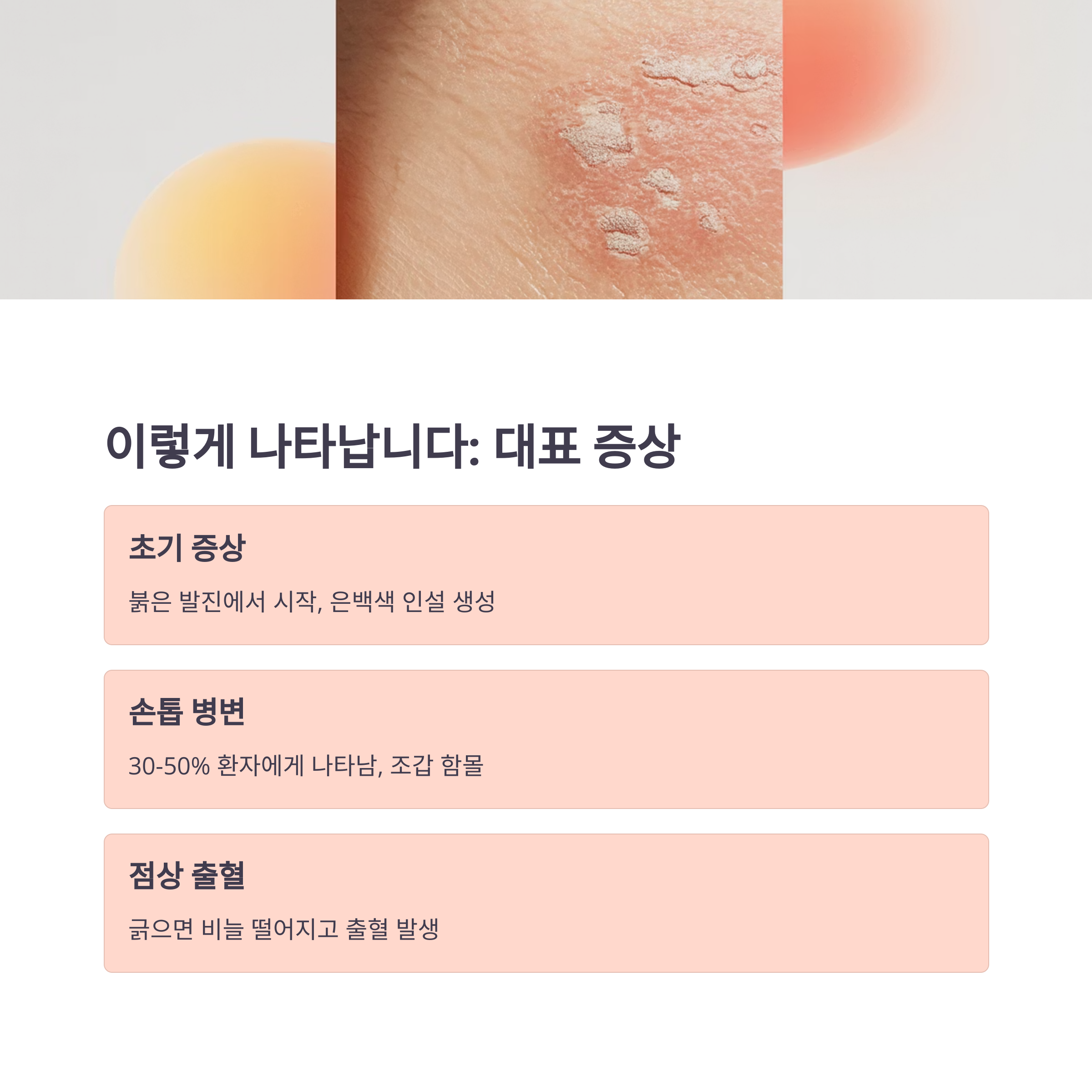 붉은 반점, 은백색 인설, 손톱 병변 등 대표적인 건선 증상을 설명한 이미지