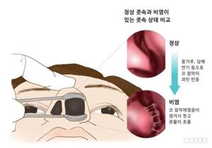 비염코막힘