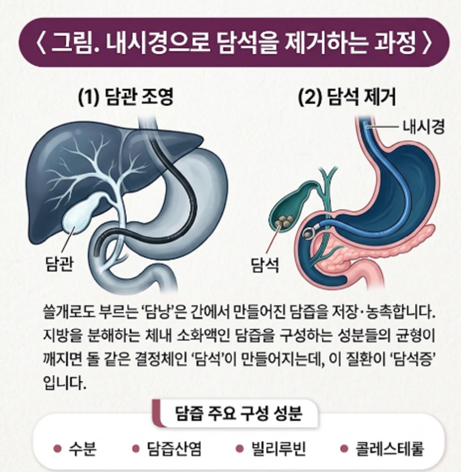 담석제거술-천영국-교수