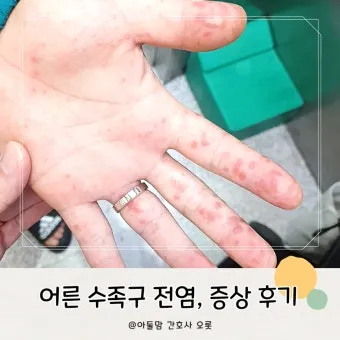 수족구 어른 전염에 대한 원인과 예방법 정리_23