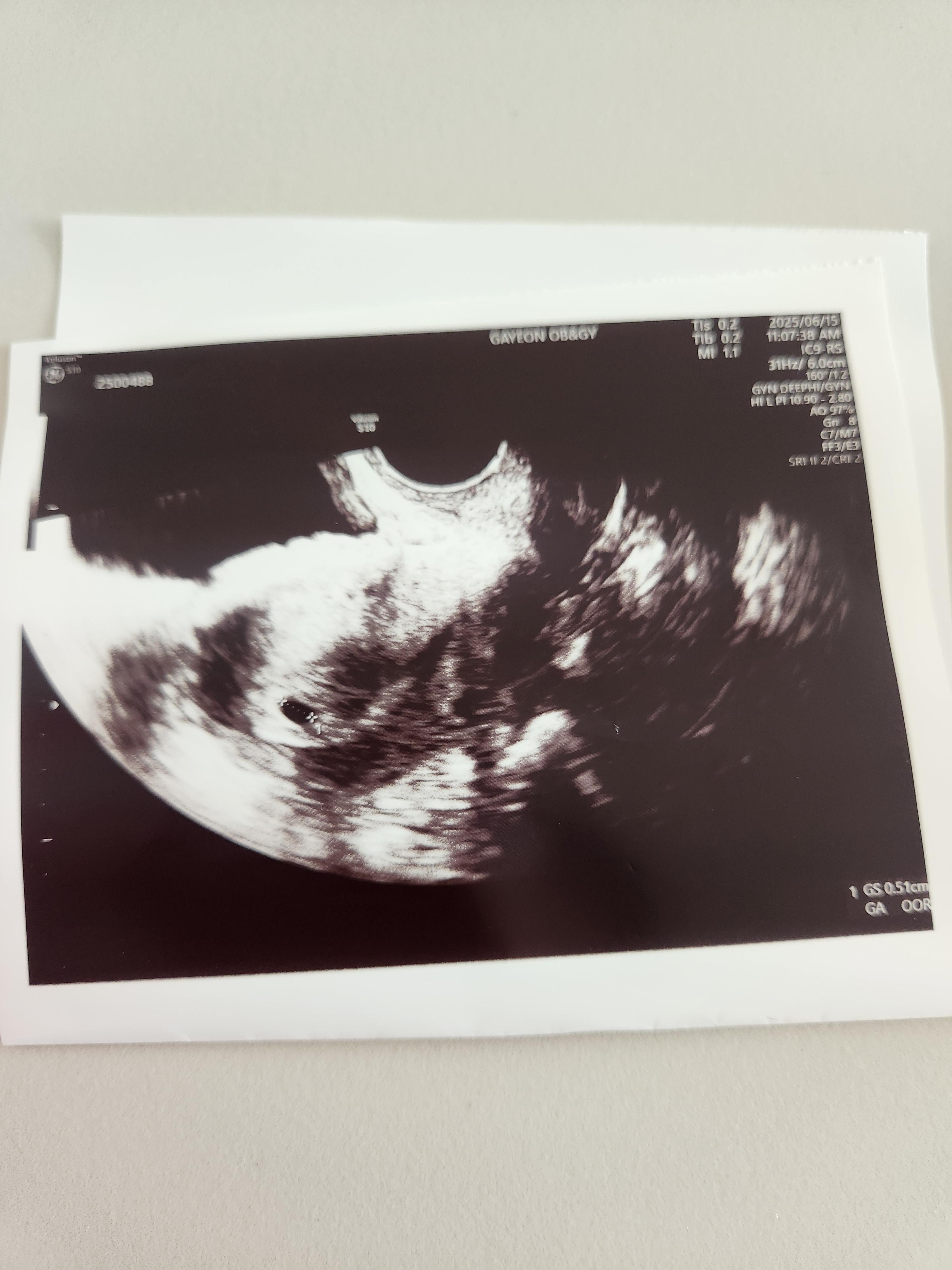 아기집 초음파, 임신5주차 초음파