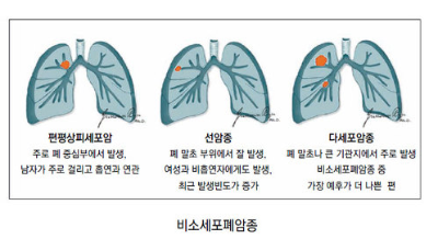비소세포폐암