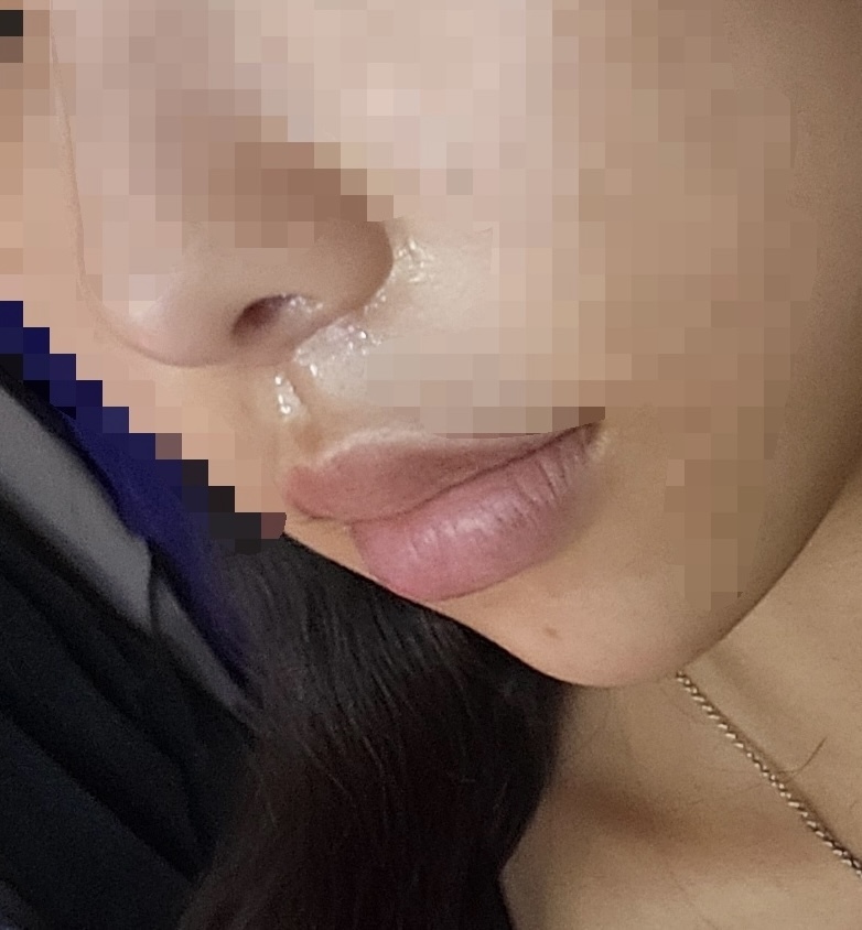 인중 축소 수술 후기