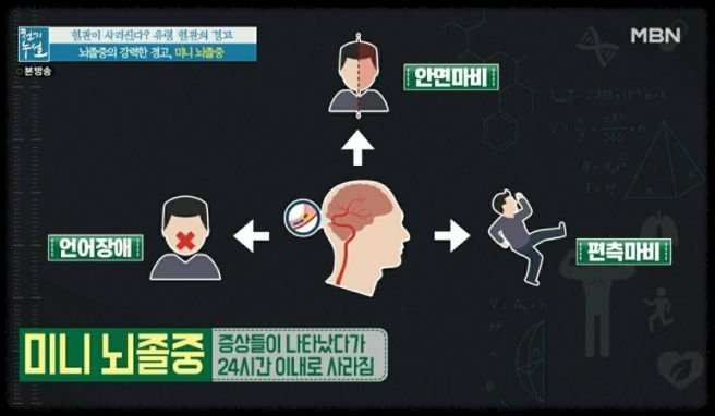 뇌졸중 증상과 예방방법, 꼭 알아야 할 팁