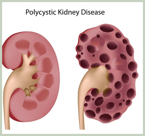 만성신부전은 손바닥이 노란원인이 됨