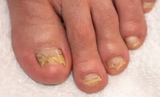 무좀균에 감염된 발톱