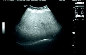 지방간 없애는 방법