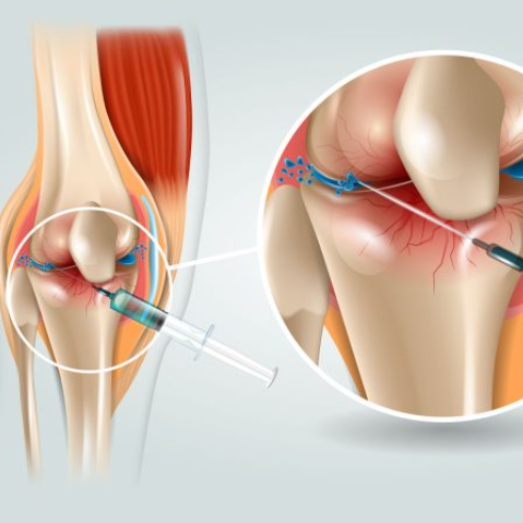 무릎 연골주사 종류 가격 및 부작용