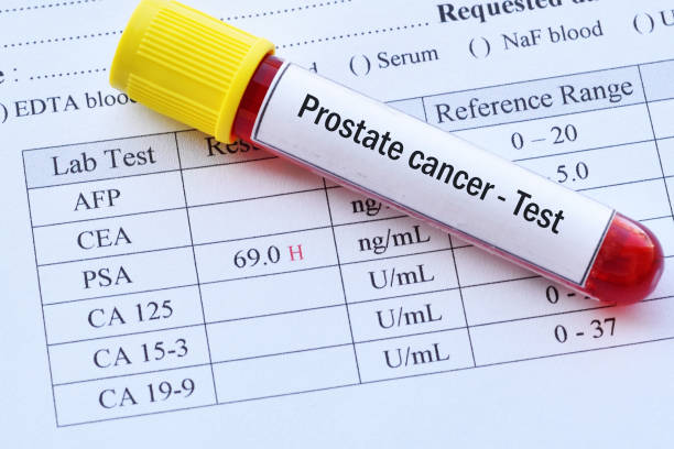 gleason score 전립선암 system score 점수 grade 그레이드 group 악성도 PSA prostate cancer prognosis 악성 분화 예후 글리슨 크기 스코어 등급 5 6 7 8 글리슨점수7이란 조직검사 글리슨수치