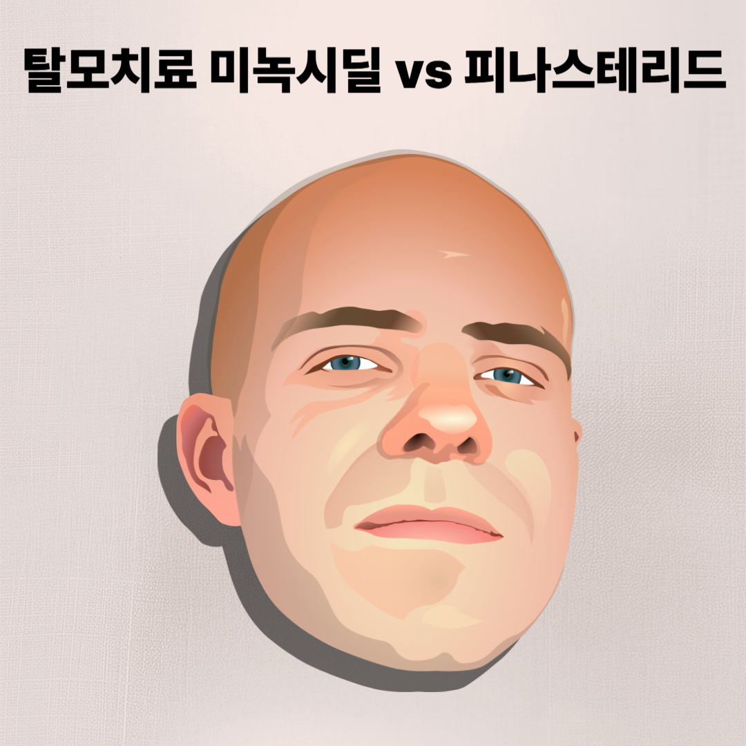 탈모치료 미녹시딜 vs 피나스테리드, 후기 중심 비교 리뷰