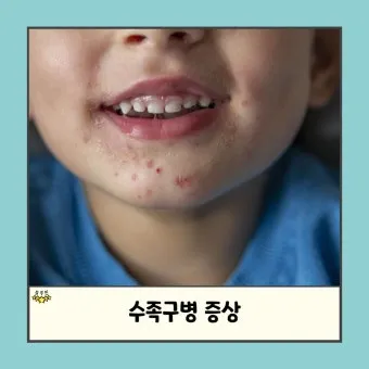 수족구 어른 전염에 대한 원인과 예방법 정리_6