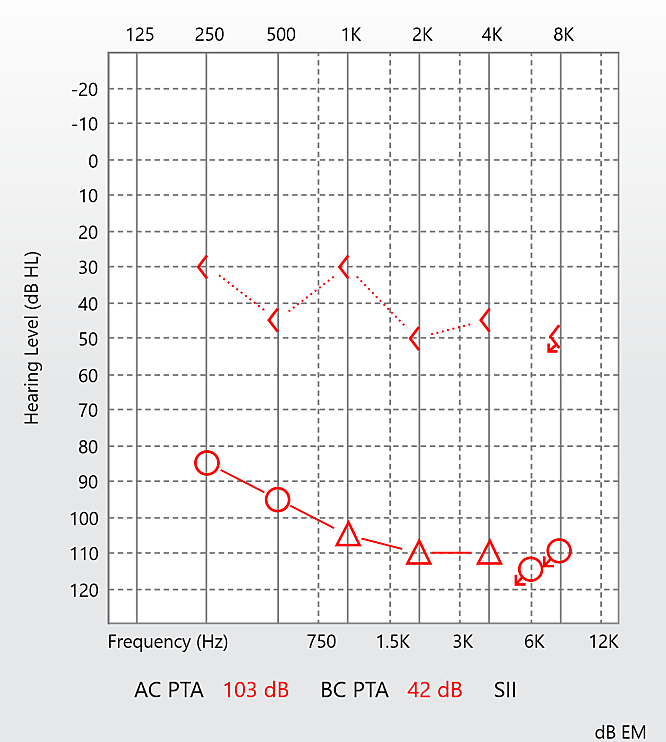 편측성 난청인 우측 청력도