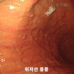 위저선 용종