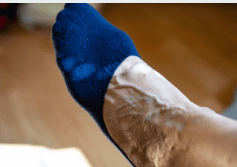 하지 정맥류 증상 수술비용