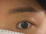 결막모반 제거 후기