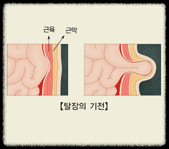 탈장의 기전