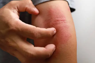 피부 붉은반점 14