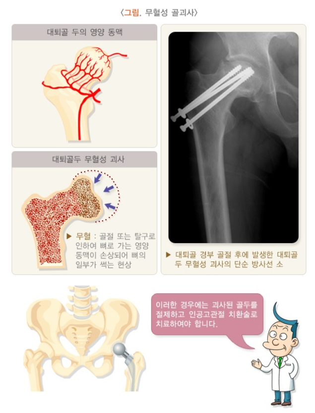 무혈성괴사 이미지
