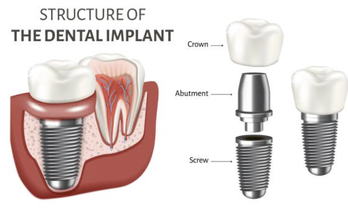국산 임플란트 종류