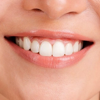 치아미백효과비추천